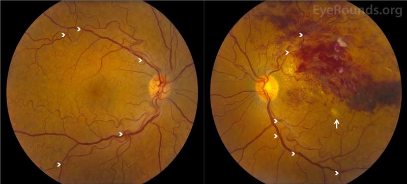 Color fundus photography, OU:  There was marked vascular tortuosity with AV nicking OU (arrowheads). There was a recurrent BRVO along the superior arcade with massive intraretinal and retinal nerve fiber layer hemorrhages OS. There were hard exudates throughout the superior macula with a few, scattered cotton wool spots OS. There was a central macular hypopigmented lesion with a small amount of subretinal fluid OS (arrow).