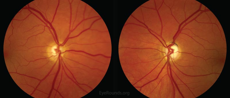 Color fundus photographs, OU. The optic nerves show peripapillary atrophy with relative thinning of the neuroretinal rim inferiorly and superiorly OU. 
