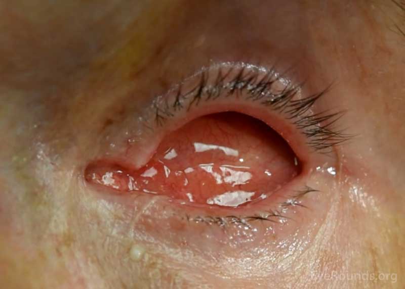 Examples of eye sockets after evisceration (left) and enucleation (right). Note that both sockets appear similar, regardless of the surgical technique used.