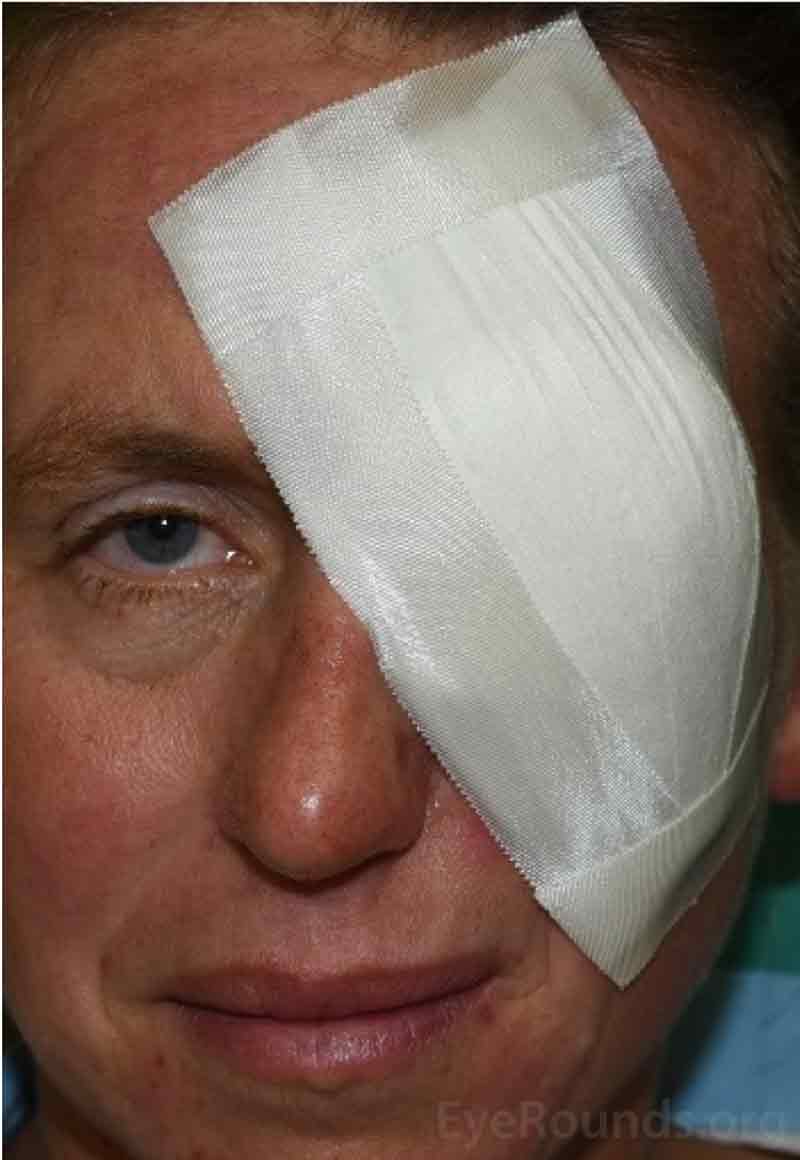 Examples of the patch placed over the eye immediately after the eye removal surgery. 