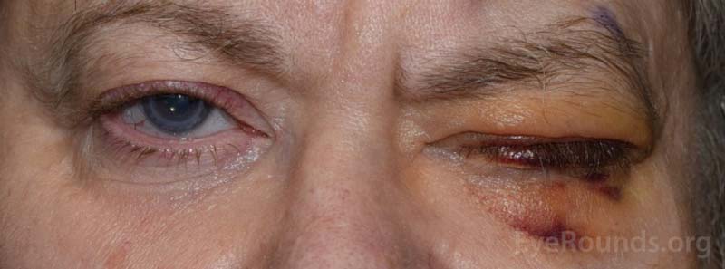 Example of the bruising and swelling that is typical after eye removal surgery. Note that patients often have their eyelid temporarily sewn shut to promote healing.