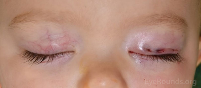 Example of the bruising and swelling that is typical after eye removal surgery. Note that patients often have their eyelid temporarily sewn shut to promote healing.