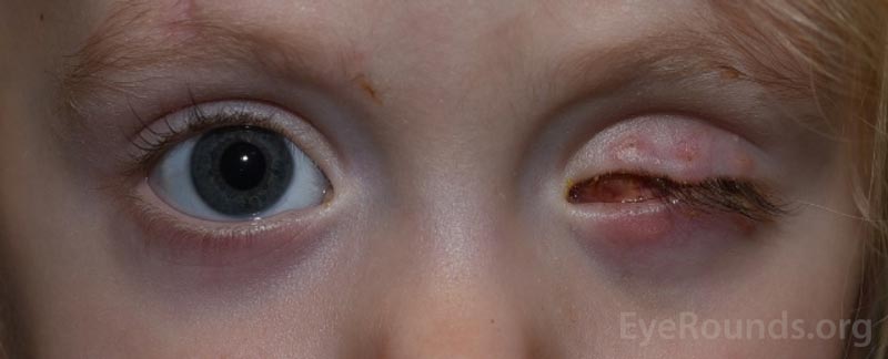 Example of the bruising and swelling that is typical after eye removal surgery. Note that patients often have their eyelid temporarily sewn shut to promote healing.