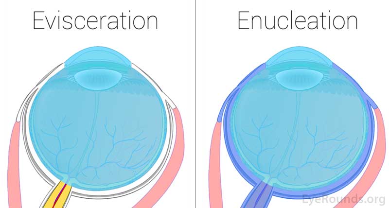 Figure 2a. This graphic highlights the tissues removed during an evisceration. Figure 2b. This graphic highlights the tissues removed during an enucleation. 