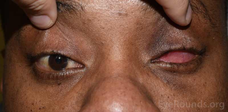 Example of a fully healed eye socket with (left) and without (right) the conformer in place.