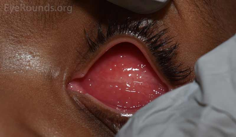 Example of a fully healed eye socket with (left) and without (right) the conformer in place.