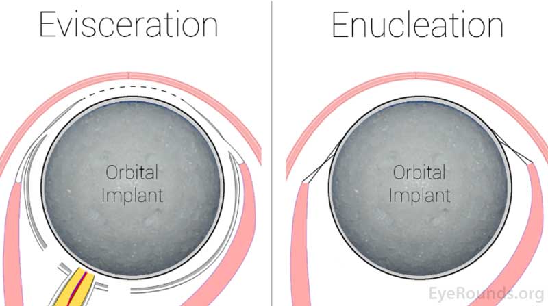 This graphic depicts the placement of the orbital implant into the eye socket after the patient's has been removed via either evisceration or enucleation.