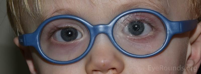 Example of patient wearing protective polycarbonate lenses. 