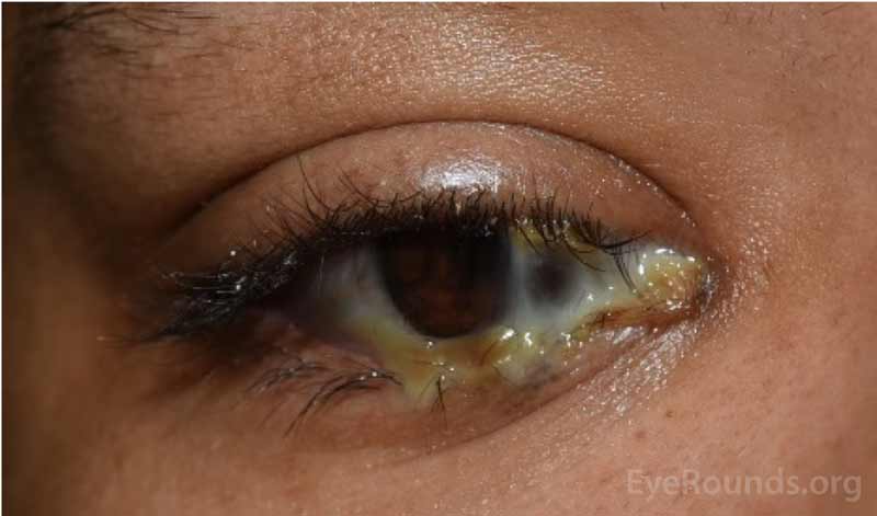 Example of eye sockets that have become infected. Note the presence of pus.