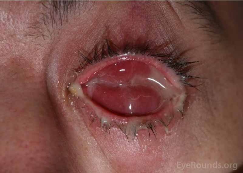 Example of eye sockets that have become infected. Note the presence of pus.