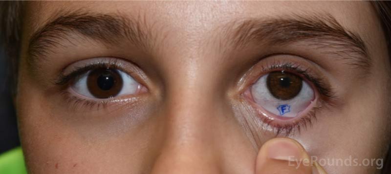 Example of customized prosthetic.