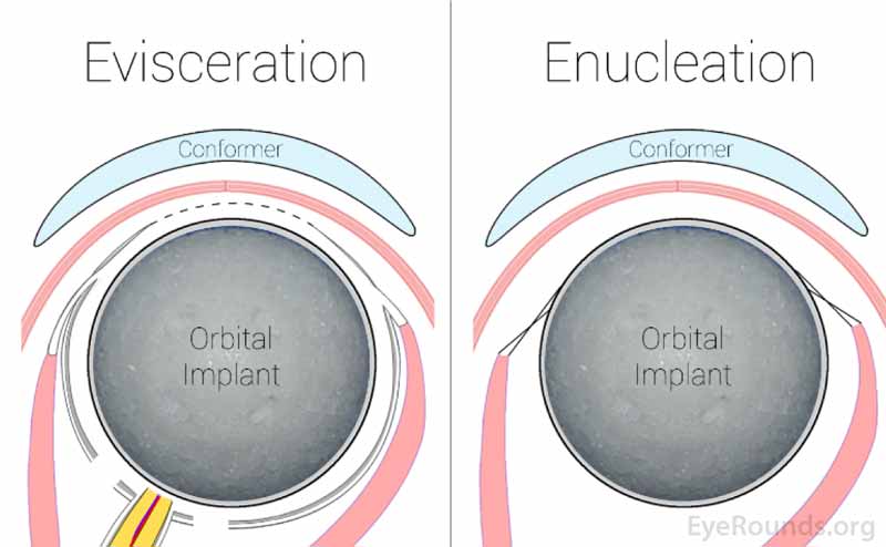 This graphic shows where the conformer sits in the eye socket. 