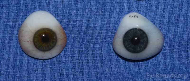 Examples of prosthetic eyes.