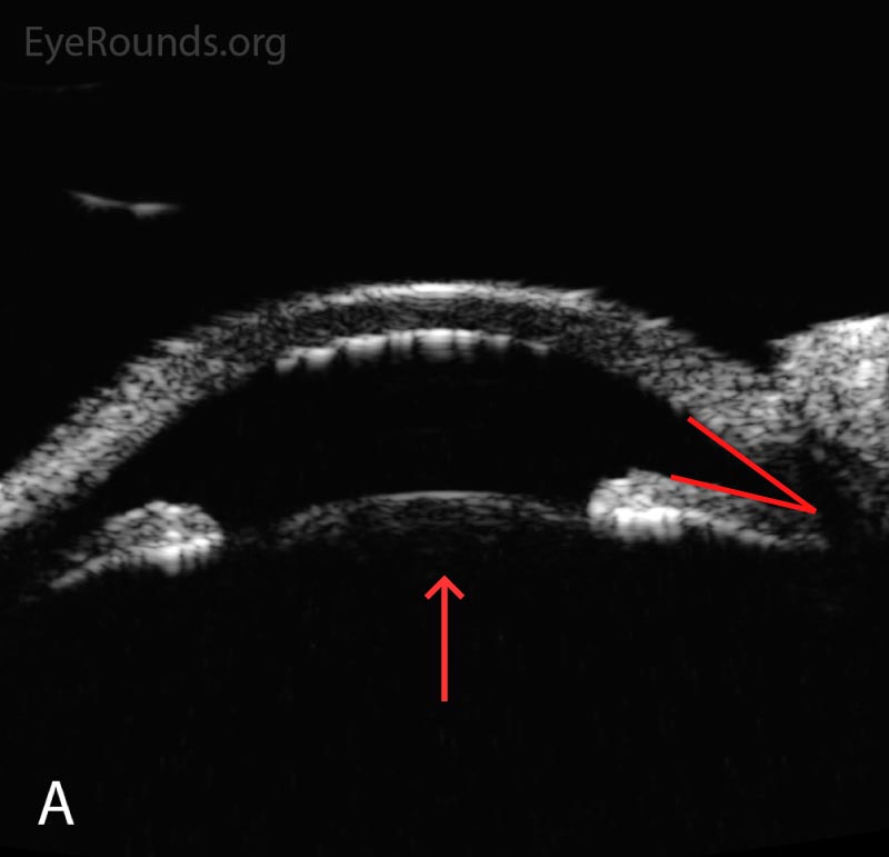 Anterior segment ultrasound of the anterior chamber (A) with attention focused to the ciliary body (B) at two-day follow-up. The anterior chamber is shallow; the angles are narrowed (red angle); the lens-iris diaphragm is displaced forward (red arrow); and the ciliary body is rotated anteriorly (red asterisk). The left eye had a similar appearance. 