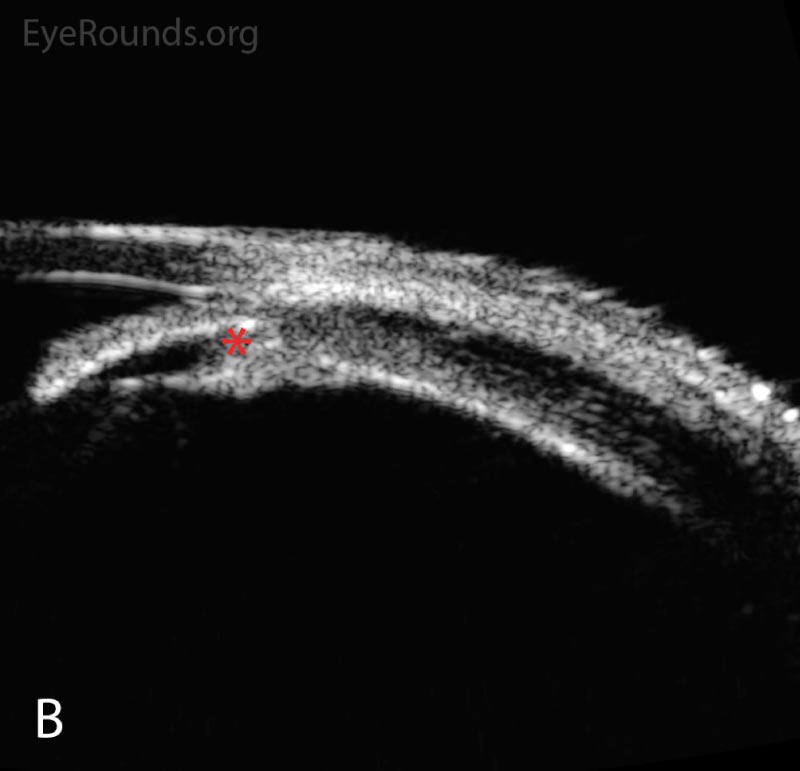 Anterior segment ultrasound of the anterior chamber (A) with attention focused to the ciliary body (B) at two-day follow-up. The anterior chamber is shallow; the angles are narrowed (red angle); the lens-iris diaphragm is displaced forward (red arrow); and the ciliary body is rotated anteriorly (red asterisk). The left eye had a similar appearance. 