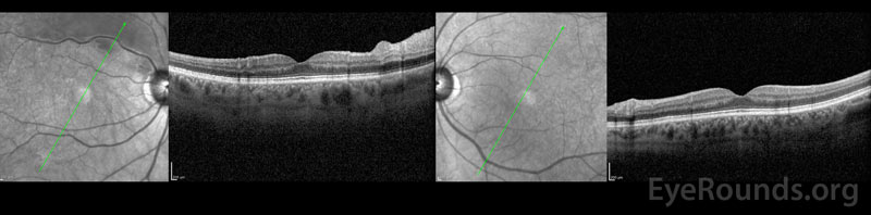 OCT of the right eye is significant for diffuse inner retinal thickening extending along the superior arcade