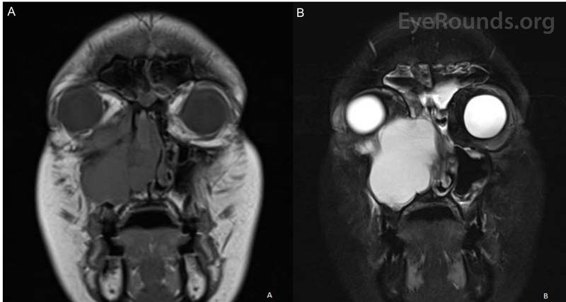 MRI of the face and sinuses with and without intravenous contrast demonstrating a right-sided mass centered on the maxillary sinus abutting the orbit exhibiting no enhancement on T1 (panel A) and enhancement on T2 (panel B).