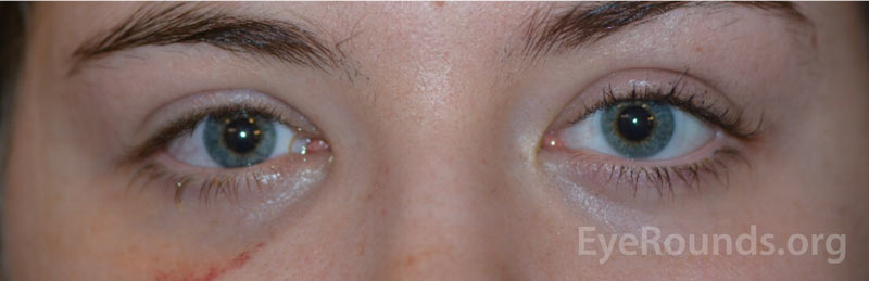 Post-operative external photograph demonstrating resolution of patient's previous exophthalmos with new right-sided enophthalmos. 