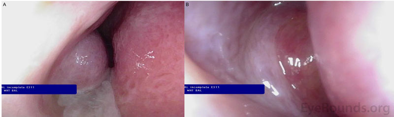 Pre-operative nasal endoscopy showing increased purulent mucous from the right inferior meatus and nasal cavity (panel A) and a mass obstructing the middle meatus (panel B).