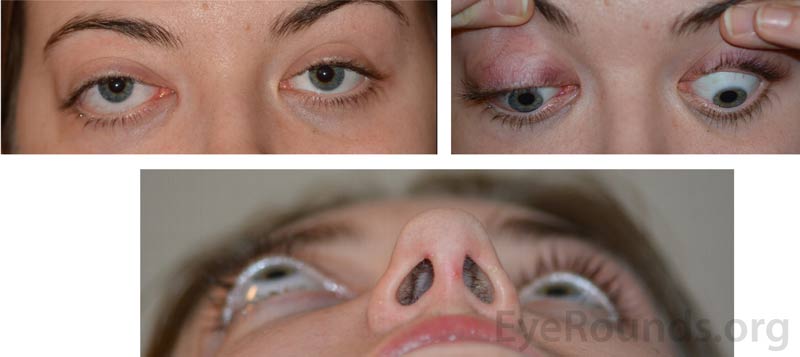 Pre-operative external photographs demonstrating right-sided exophthalmos, and inferior scleral show.