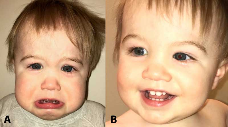 Full face photographs demonstrating increased tear lake and mucoid discharge in the right eye consistent with nasolacrimal duct obstruction. Symptoms were exacerbated during periods of crying (photograph A). The tearing of the left eye in photograph B is secondary to recent crying.