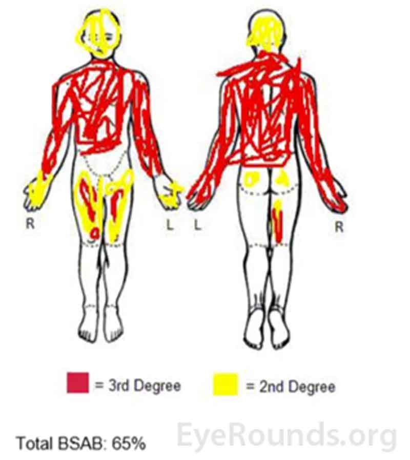 Burn diagram demonstrating location and extent of the patient's burn injuries. Note that injuries encompass a large total body surface area (65%), are mostly full thickness, and involve the periorbital region.