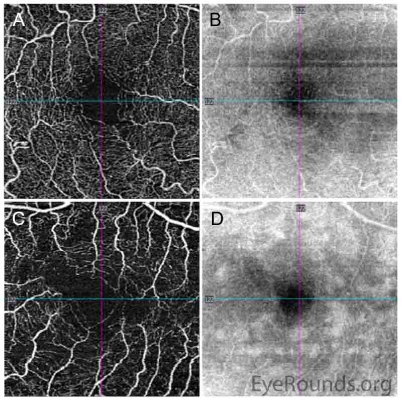 Optical coherence tomography angiography (3×3 mm) of the superficial capillary plexus. There is mild irregularity of the foveal avascular zone in the right eye (A, angiogram), with homogeneous reflectivity pattern on the corresponding en face structural slab (B). The left eye has an irregular foveal avascular zone with perifoveal vascular flow loss (C), and splotchy irregularity en face (D) corresponding to the hyperreflectivities seen on the OCT macula line scans in Figure 3.
