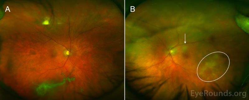  Color fundus photograph