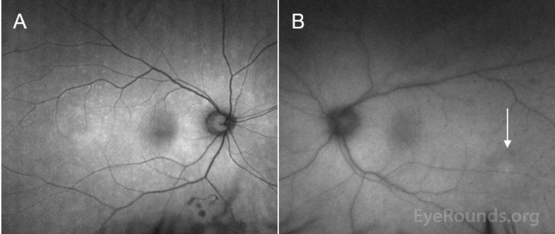  Fundus autofluorescence image