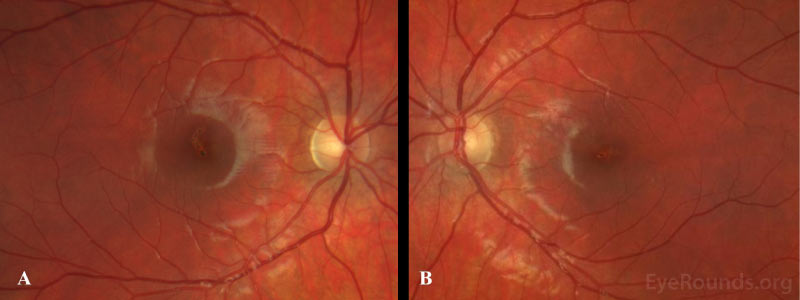 Color fundus photograph of the right macula