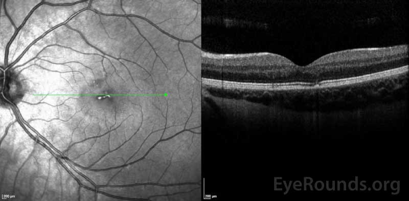 OCT of the left macula showing parafoveal ellipsoid zone disruption.