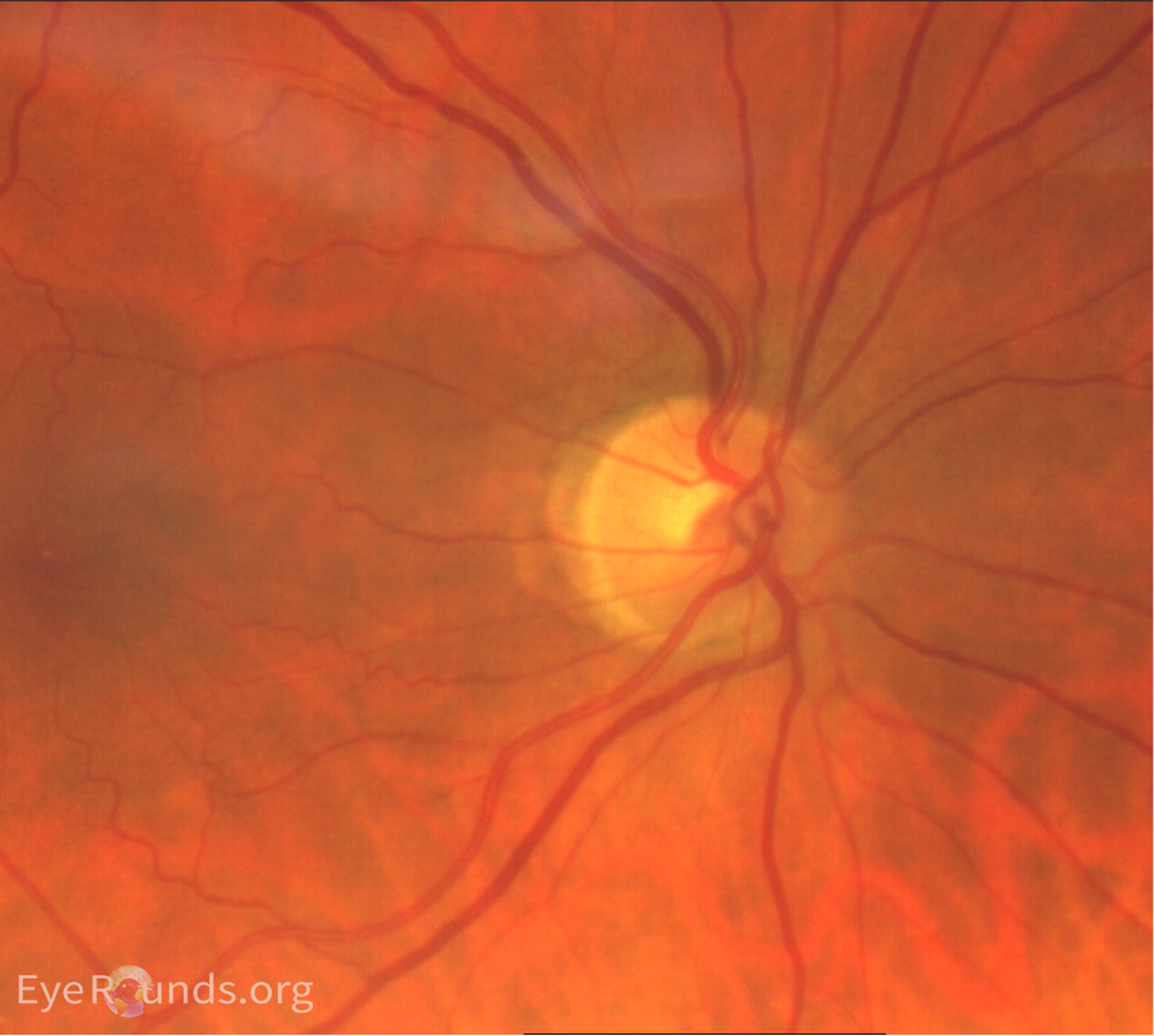 Color fundus photo: OD temporal scleral crescent, normal disc