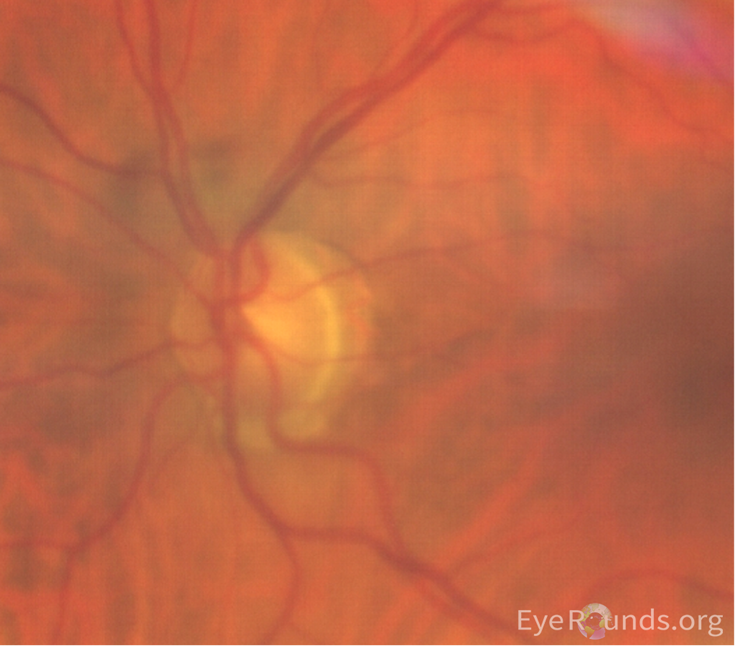 Color fundus photos: OS temporal scleral crescent, no notable disc pallor