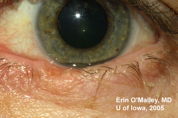 EyeRounds.org: Nodular Basal Cell Carcinoma: 49 year-old female with