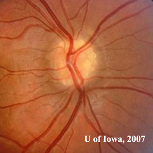 Related Case: Optic Nerve Drusen