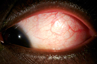 Erythema Multiforme figure 1 b