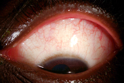 Erythema Multiforme Figure 1C