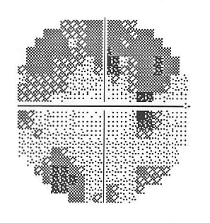 Juvenile Open Angle Glaucoma - Myocilin