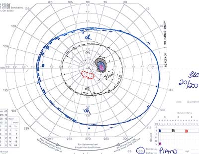 Goldmann visual field, right eye