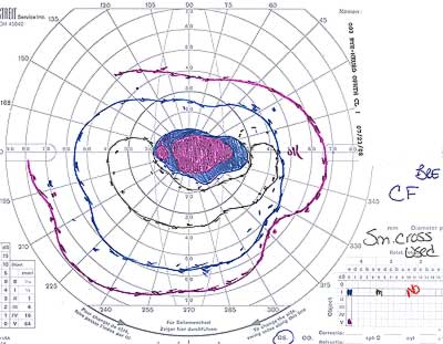 Goldmann visual field, left eye