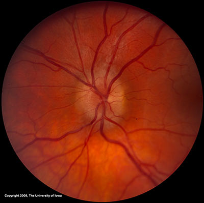 Optic disc edema