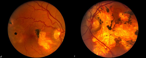 Serpiginous Choroiditis