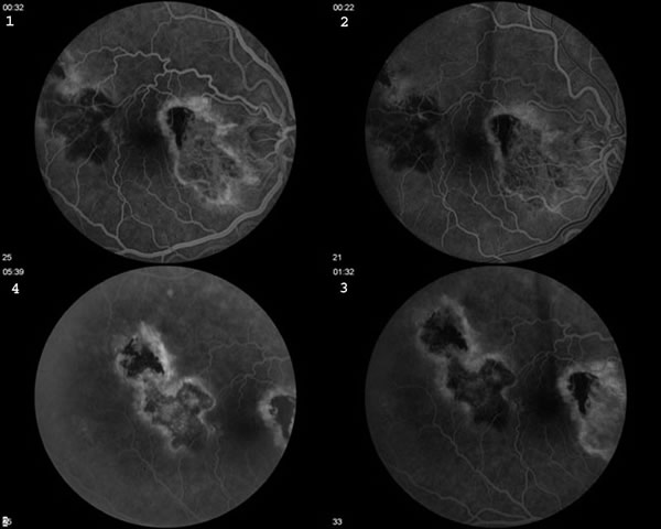 Serpiginous Choroiditis