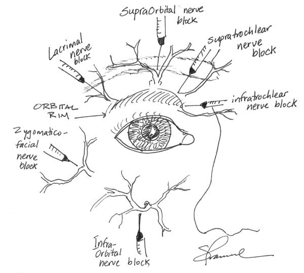 Retrobulbar Block, Peribulbar block and Common Nerve