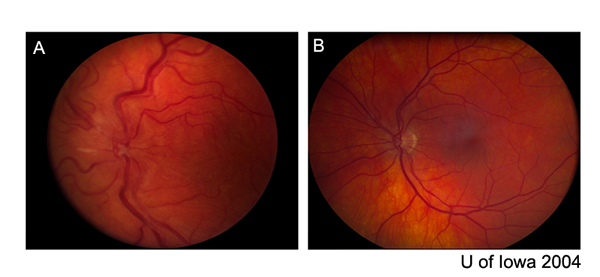 Hypotonous Maculopathy