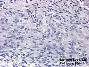 Pathology of Iris Melanoma