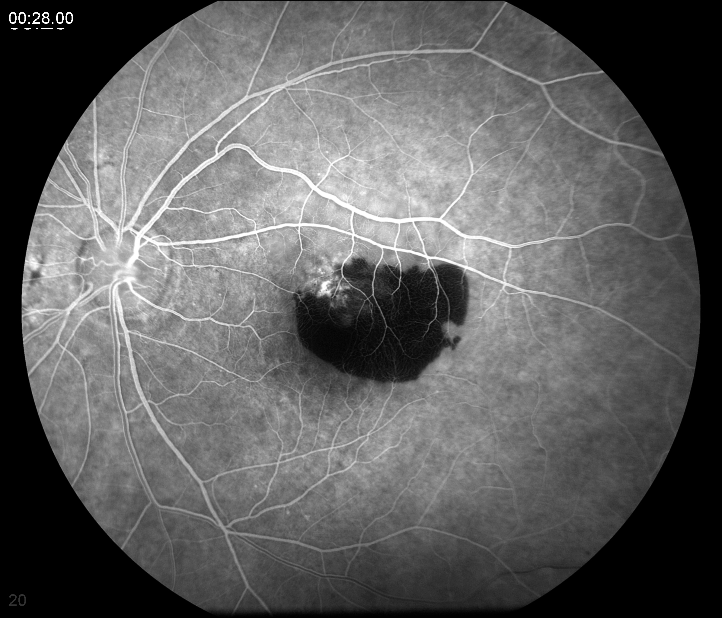 Fluorescein angiogram demonstrating hypofluorescence of the subretinal hemorrhage and hyperfluorescence of the leaky CNV