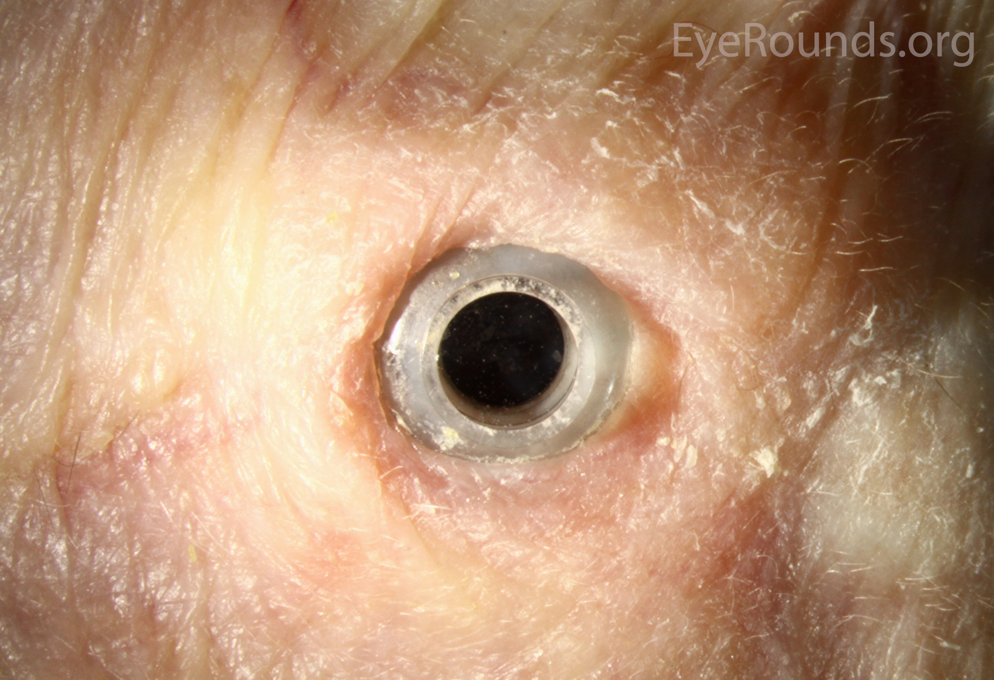 Boston Type II KPro for severe ocular cicatricial pemphigoid