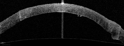 Fig 7b: Normal anatomy is restored with reattachment of Descemet membrane to the donor stroma after placement of an air bubble in the anterior chamber.