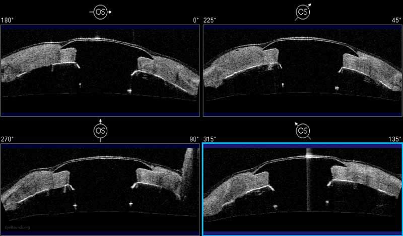 Figure 18: Anterior segment optical coherence tomography demonstrating the appearance of a Boston Type I Kpro with healthy corneal tissue surrounding the device.